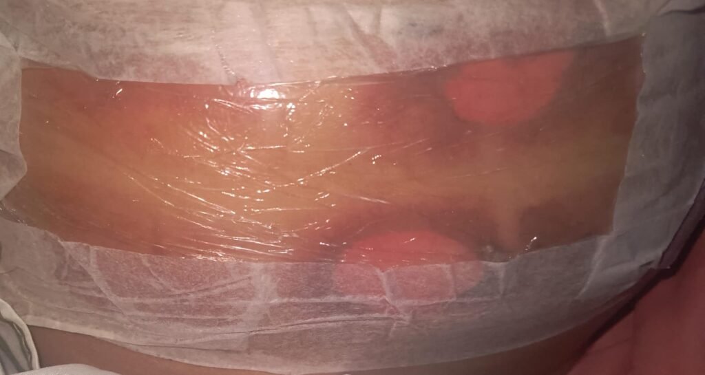 Una vecina denuncia quemaduras tras realizarse una criolipólisis, un tratamiento estético en una estética del barrio
